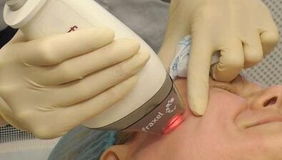 Fraksiyonel cilt gençleştirme nasıl yapılır