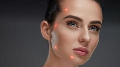 Fraksiyonel cilt gençleştirme nedir