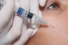 Biorevitalizasyon prosedürü
