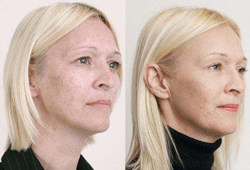 Meyve asitleri ile orta peeling