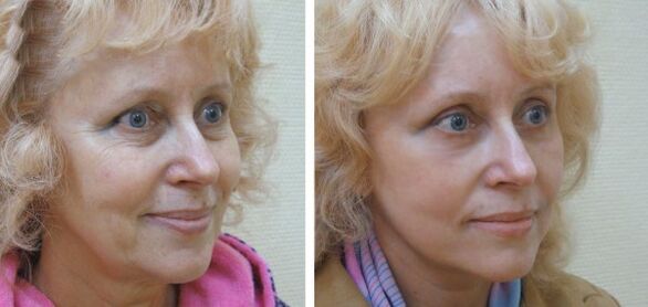 Plazma yüz cilt gençleştirme öncesi ve sonrası kadın